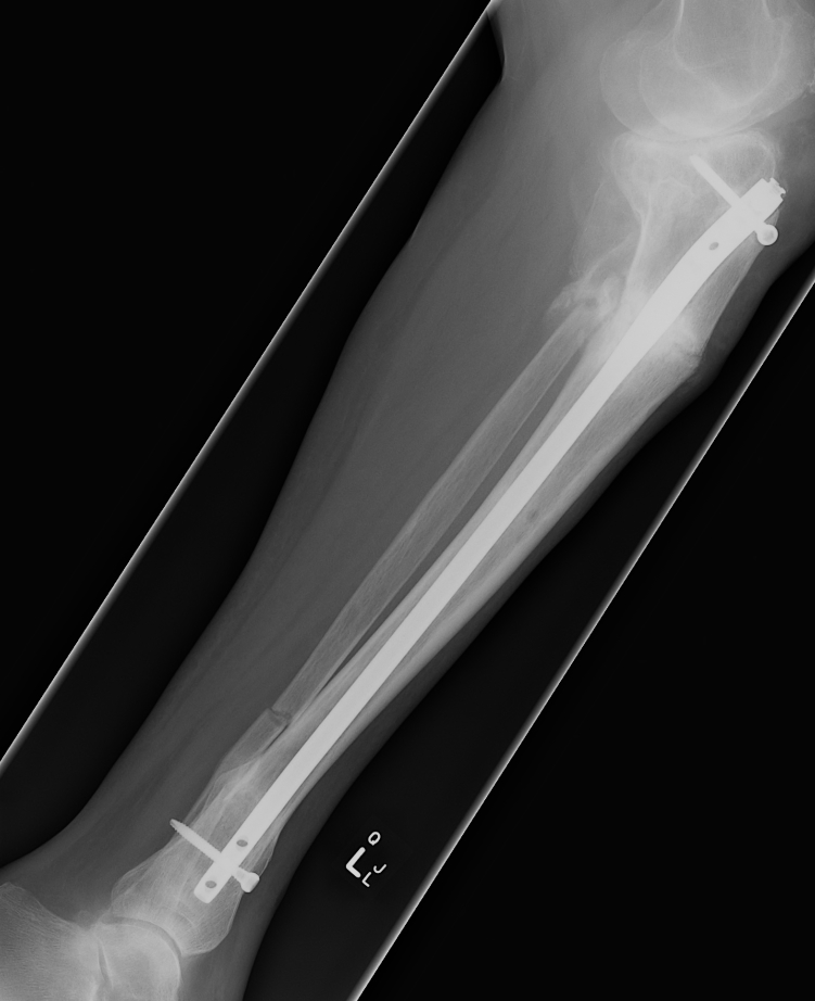 Tibial Malunion Lateral